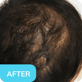 after1-1 hormonal changes
